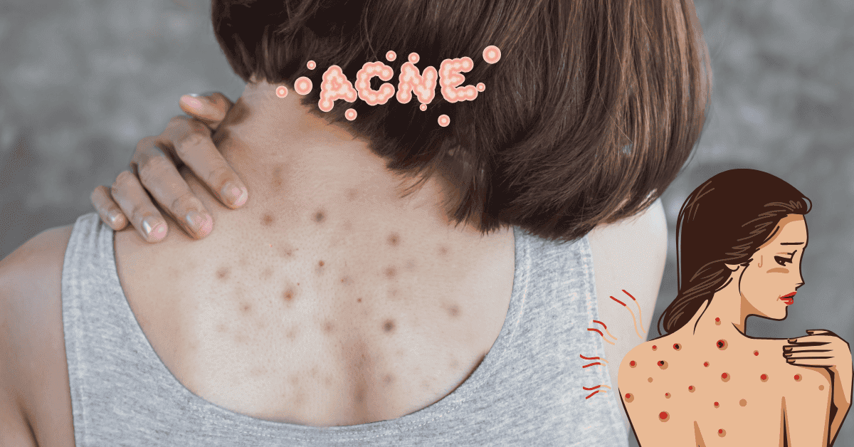 How to Get Rid of Back Acne Effective Tips and Treatments